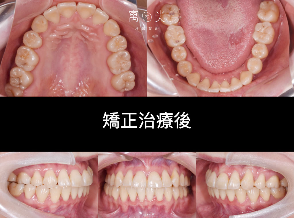 case correction 1 2 1