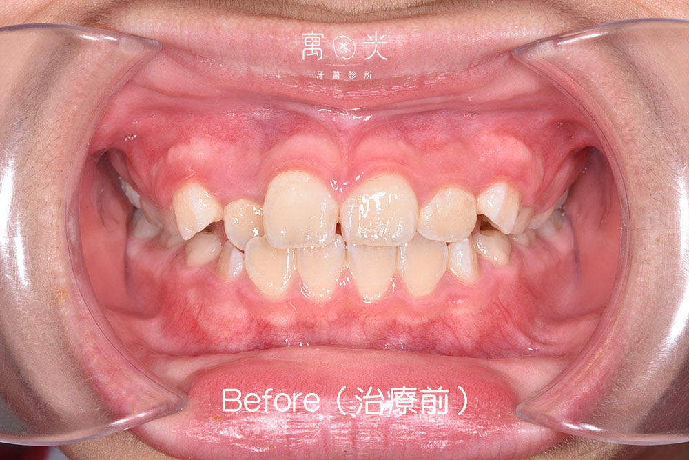 case correction 2 1 1