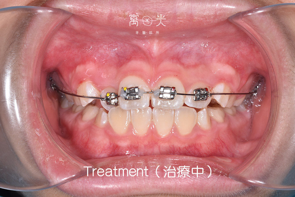 case correction 2 3 1